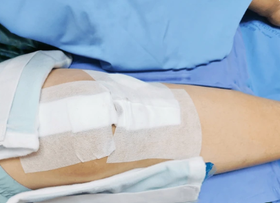 Wound Dressing